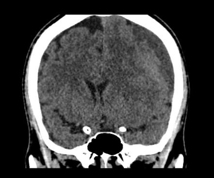 Acute on chronic subdural hematoma causing mass effect | Image ...