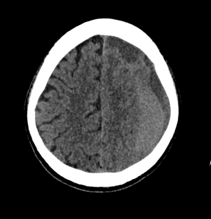 Acute On Chronic Subdural Haematoma Causing Mass Effect Radiology