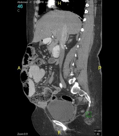 Small bowel feces sign | Radiology Case | Radiopaedia.org