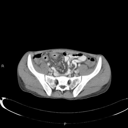 Playlist 'Nurse Practitioner education 2018 - acute abdominal imaging ...