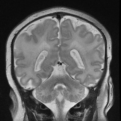 Perinatal asphyxia | Image | Radiopaedia.org