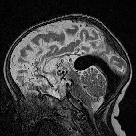 Vein Of Galen Aneurysm Fetal Ultrasound