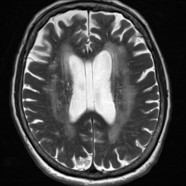 chronic-microvascular-ischemic-changes-slideshare