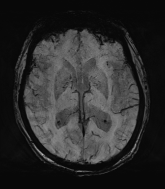 Chronic small vessel ischemia | Image | Radiopaedia.org