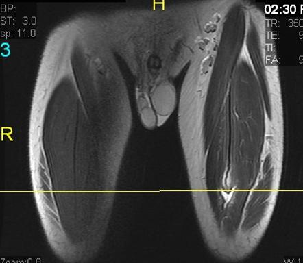 Bull's eye sign of rectus femoris injury | Image | Radiopaedia.org