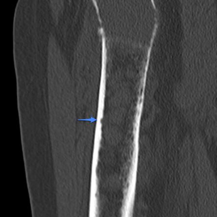 Endosteal scalloping | Radiology Reference Article | Radiopaedia.org