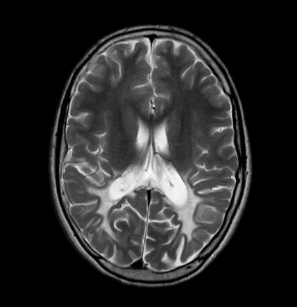 X-linked adrenoleukodystrophy | Radiology Reference Article ...