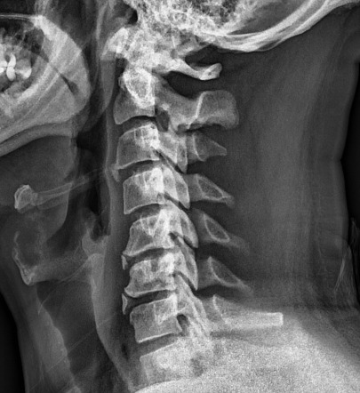 Cervical intercalary bone | Image | Radiopaedia.org