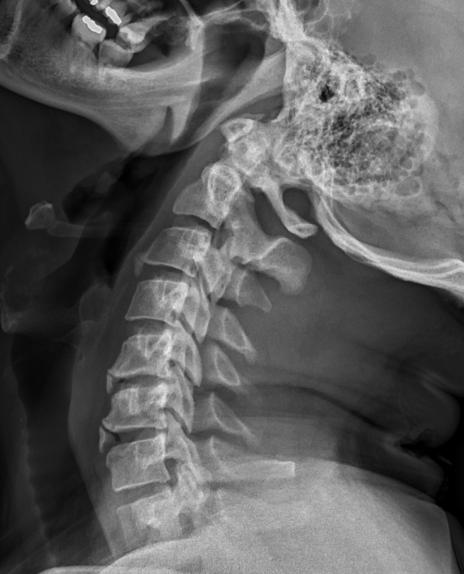 Cervical intercalary bone | Image | Radiopaedia.org