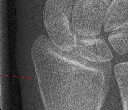 Radial Tuberosity Xray