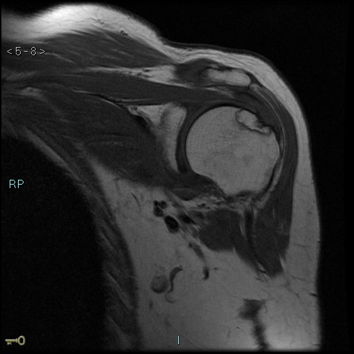 Humeral head avascular necrosis in steroid therapy | Image ...