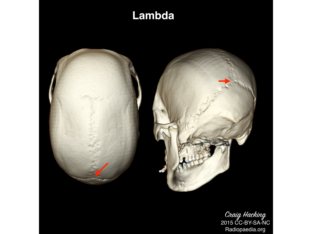 Image | Radiopaedia.org