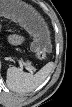 Large bowel obstruction due a colorectal carcinoma | Radiology Case ...