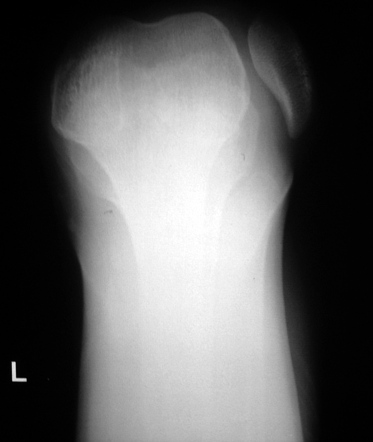 icd-10 code for lateral dislocation of right patella