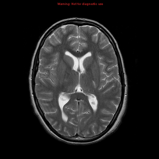 Extraskeletal Ewings sarcoma | Image | Radiopaedia.org