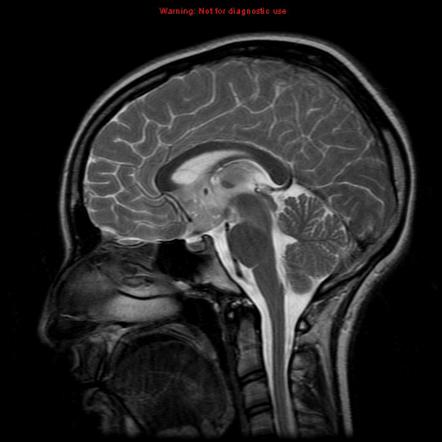 Extraskeletal Ewings sarcoma | Image | Radiopaedia.org