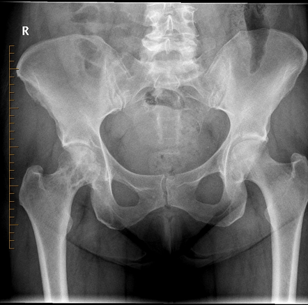 Bone metastasis - breast cancer | Radiology Case | Radiopaedia.org