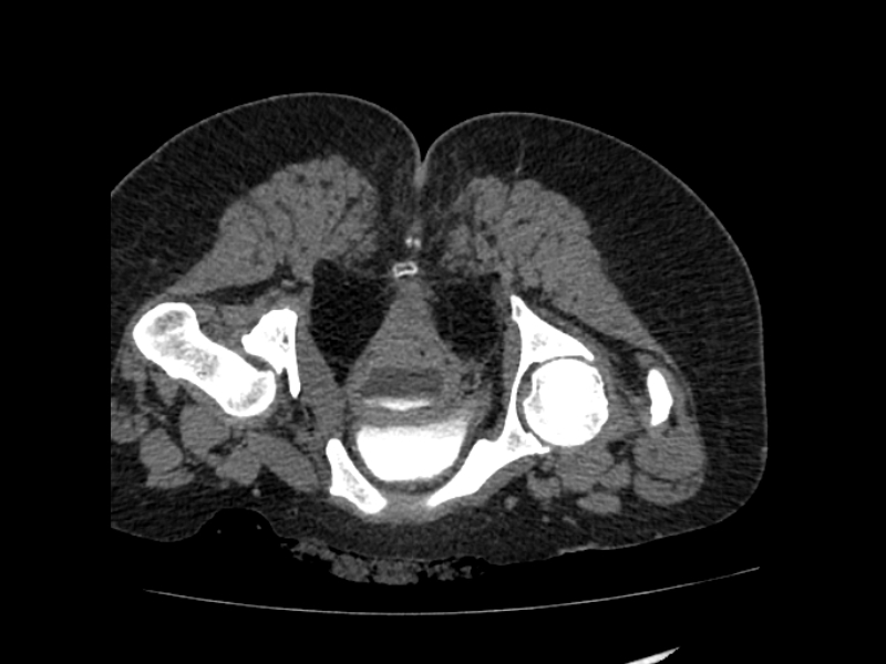 Uretero-vaginal fistula | Image | Radiopaedia.org