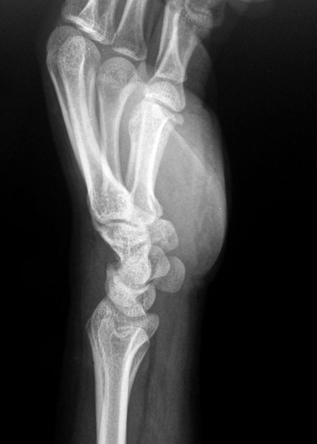 Scaphoid Fracture Mayo Middle Type Image