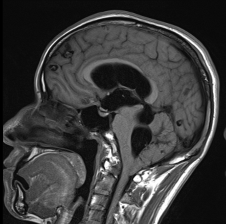 Disseminated neurocysticercosis (various stages) with hydrocephalus ...