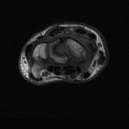 Scaphoid fracture with osteonecrosis | Image | Radiopaedia.org