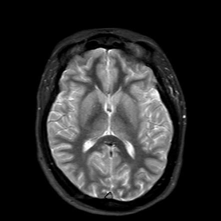 Fibrous dysplasia: involving greater wing of sphenoid bone | Image ...