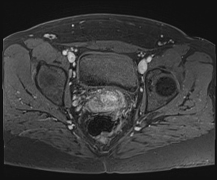 Class II Mullerian duct anomaly: unicornuate uterus with rudimentary ...