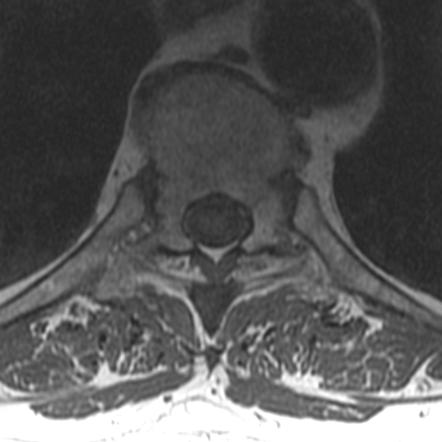 Spinous Process Metastasis In Prostate Cancer | Image | Radiopaedia.org