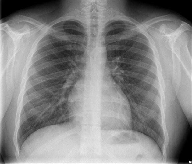 normal lateral chest xray