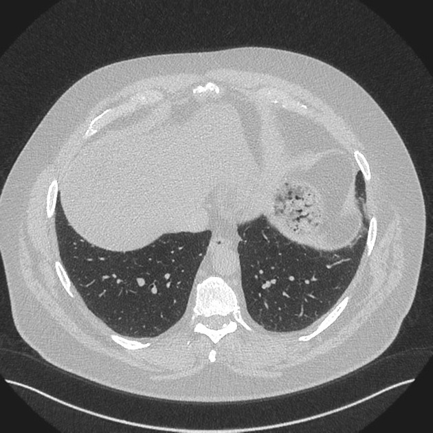 High-resolution CT | Radiology Reference Article | Radiopaedia.org