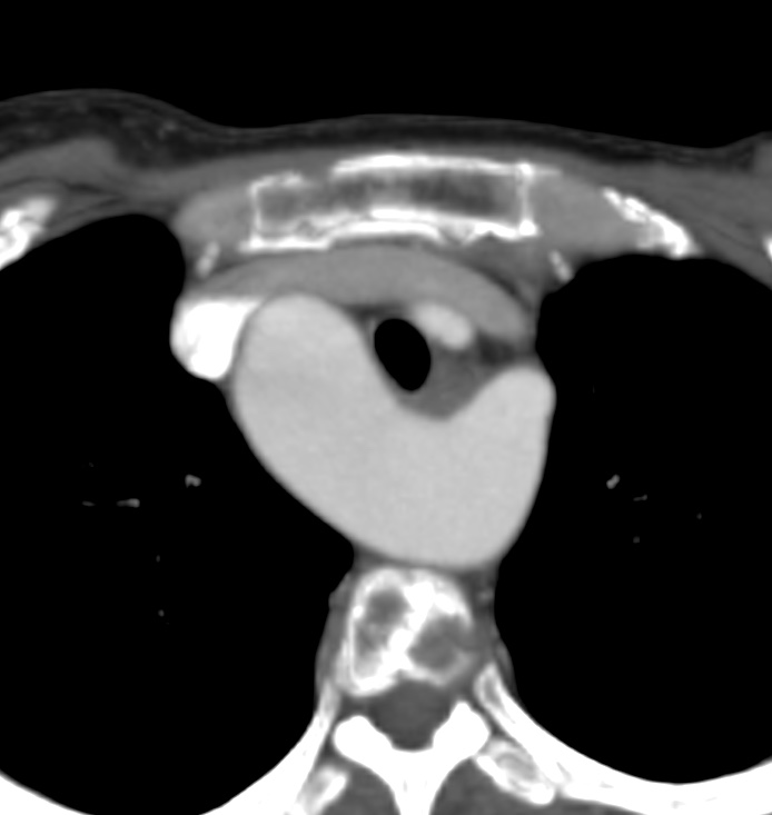 Right Sided Aortic Arch With Aberrant Left Subclavian Artery Image