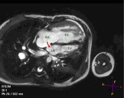 Patent foramen ovale, Radiology Reference Article