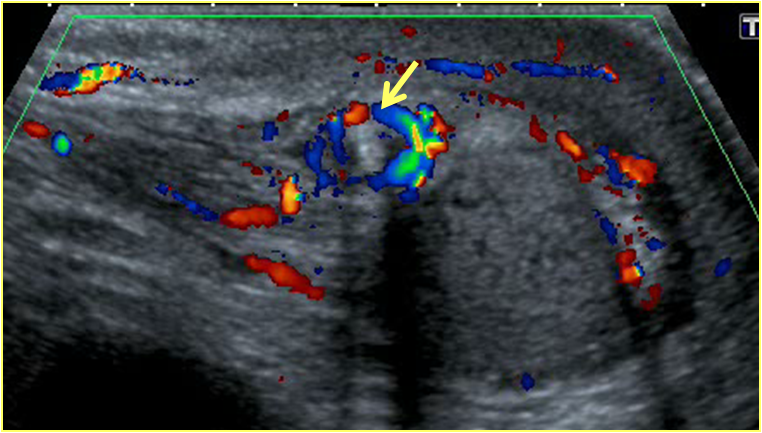 УЗИ вен семенного канатика. УЗИ органов мошонки + допплерография. УЗИ мошонки с допплерографией сосудов. Перекрут семенного канатика на УЗИ. Артерии яичка