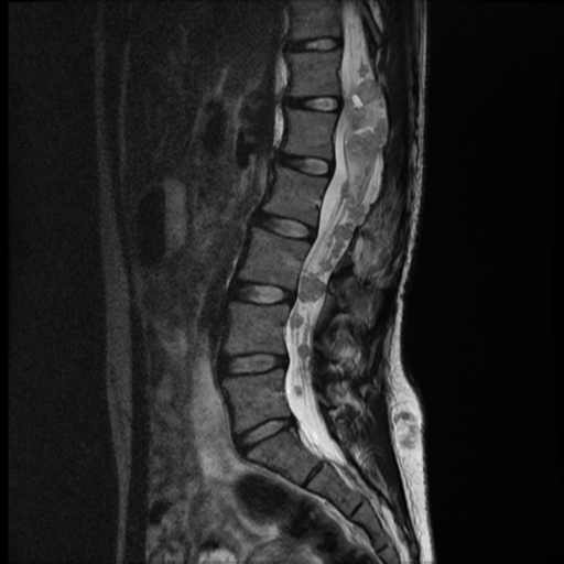 Neurofibromatosis type 2 | Image | Radiopaedia.org