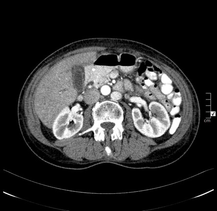 Pancreatic neuroendocrine tumor - well differentiated | Image ...