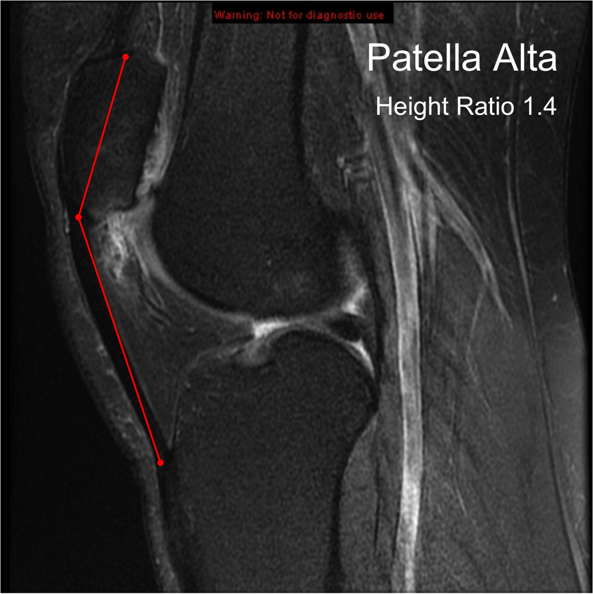 Хондромаляция надколенника рентген. Patella alta на мрт. Patella alta коленного сустава что это.