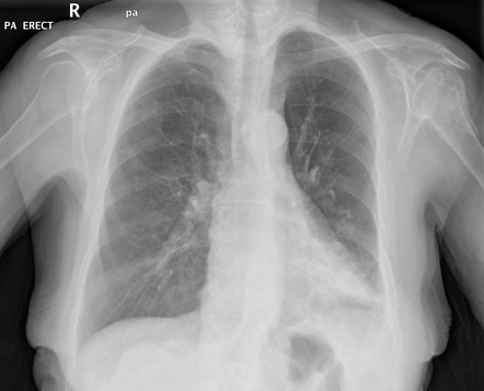 Lobar pneumonia | Radiology Reference Article | Radiopaedia.org