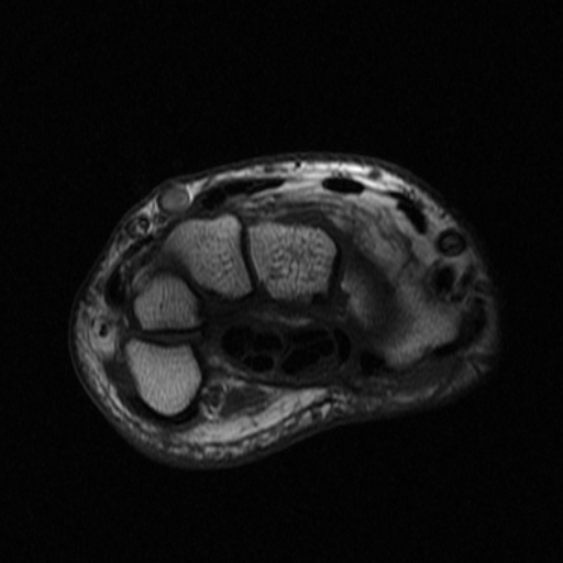 Hypothenar hammer syndrome | Image | Radiopaedia.org