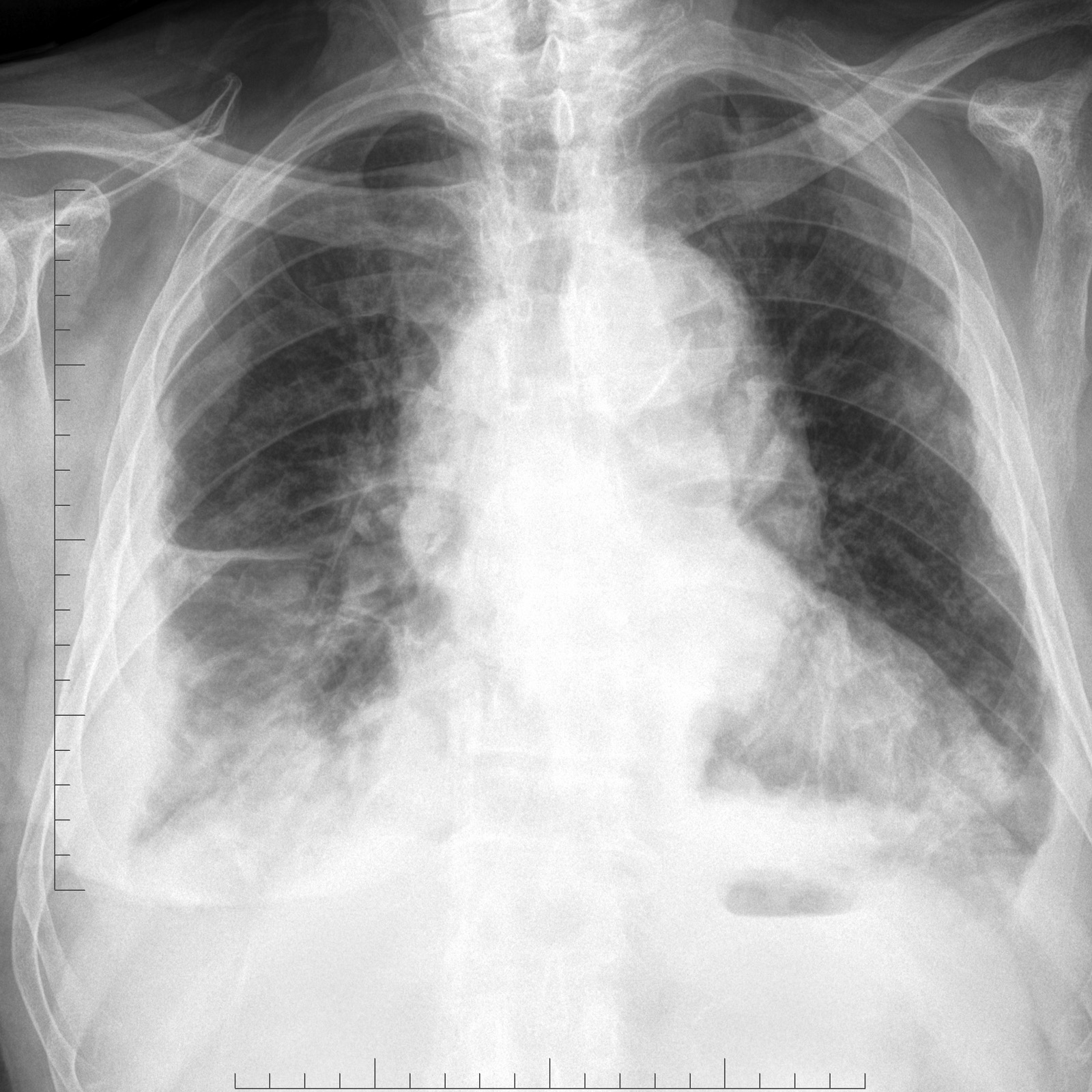 Pleural metastases - thyroid cancer | Image | Radiopaedia.org