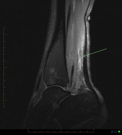 Tennis leg | Radiology Reference Article | Radiopaedia.org