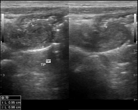 Tip appendicitis | Radiology Case | Radiopaedia.org