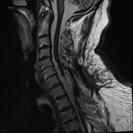 Superficial siderosis | Image | Radiopaedia.org