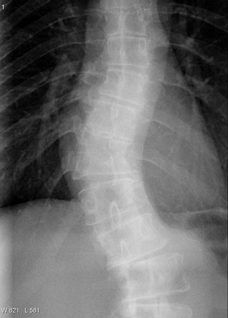 Week 2C: Sacral Vertebrae Flashcards