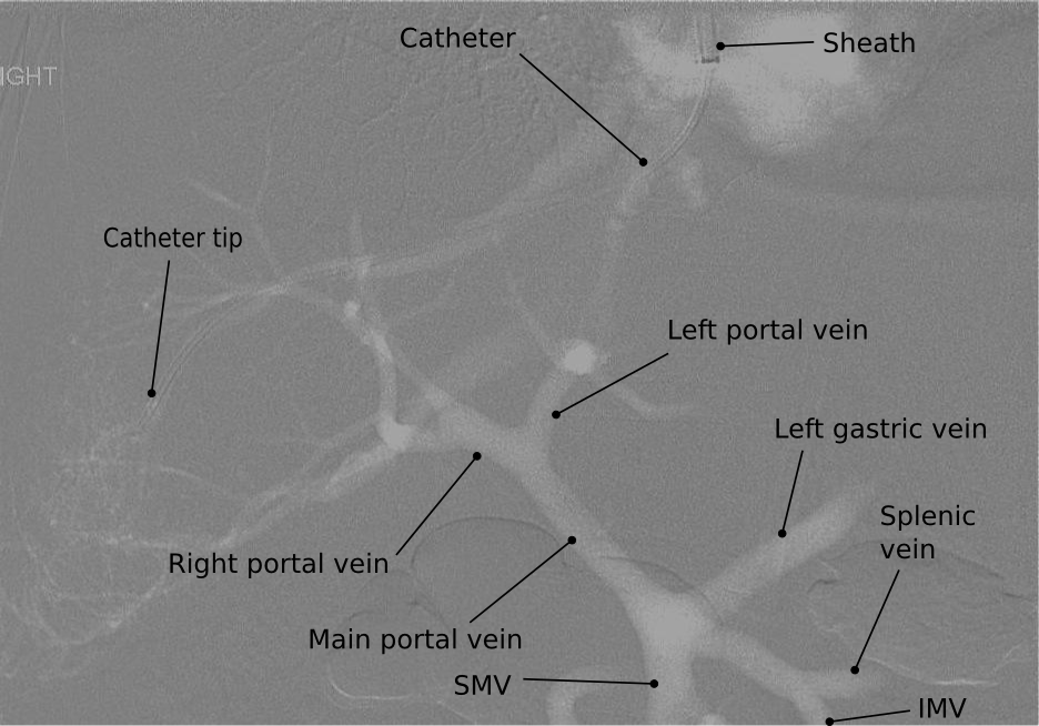 Альфа ван портал. Innominate Vein Anatomy. Double-sheathed Catheter.