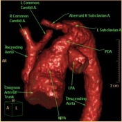 Truncus Arteriosus X Ray