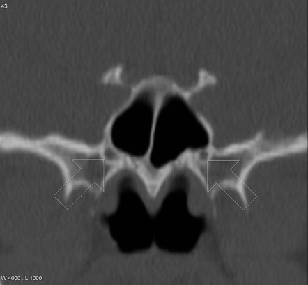 Vidian artery | Radiology Case | Radiopaedia.org