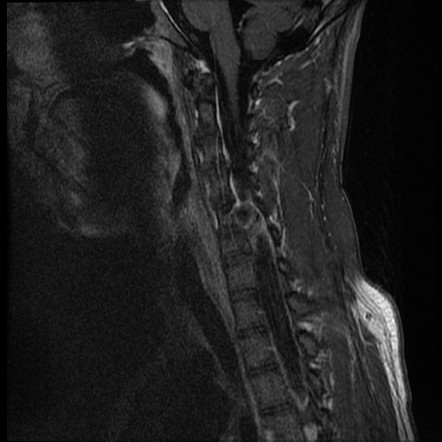 Osteochondroma - cervical spine | Image | Radiopaedia.org