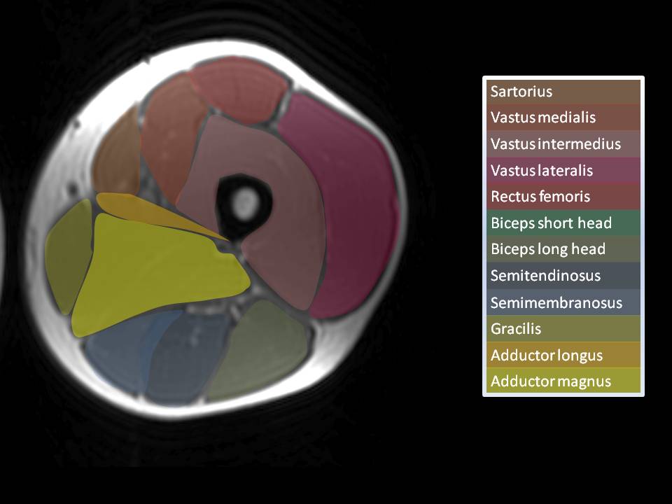 Quadriceps Muscles Axial