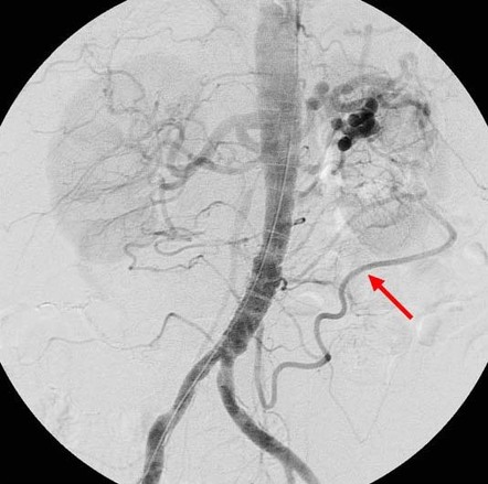 arc riolan artery mesenteric stenosis barkow angiography radiopaedia blood vascular imaging dsa quizlet colic compensatory collaterals meandering