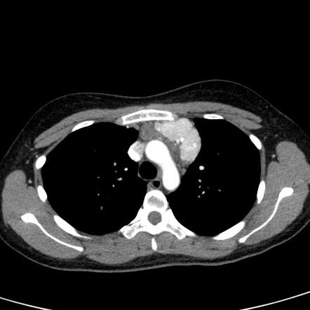 Viewing playlist: Chest Viva | Radiopaedia.org